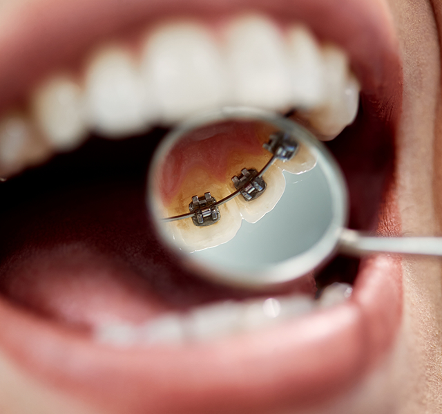 Close up of a dental mirror in a mouth reflecting teeth with lingual braces in Gilbert