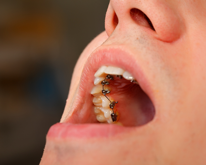 Close up of a mouth with lingual braces on the backs of the upper teeth