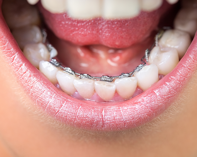 Close up of a mouth with lingual braces on the backs of the lower teeth