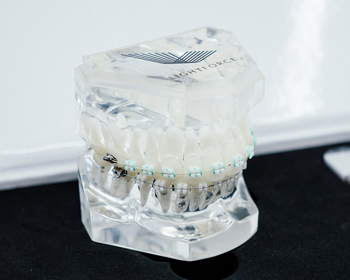 Model of the jaws with braces on the teeth