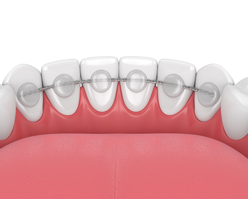 Illustration of a retainer fixed to the back of the lower teeth