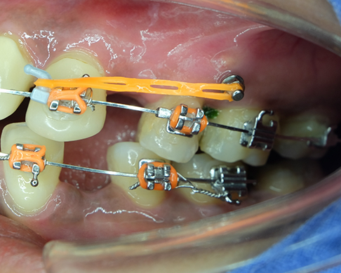 Close up of a small metal post in the gums above teeth with braces and elastic bands