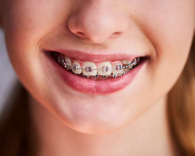 Close up of a teenager smiling with braces