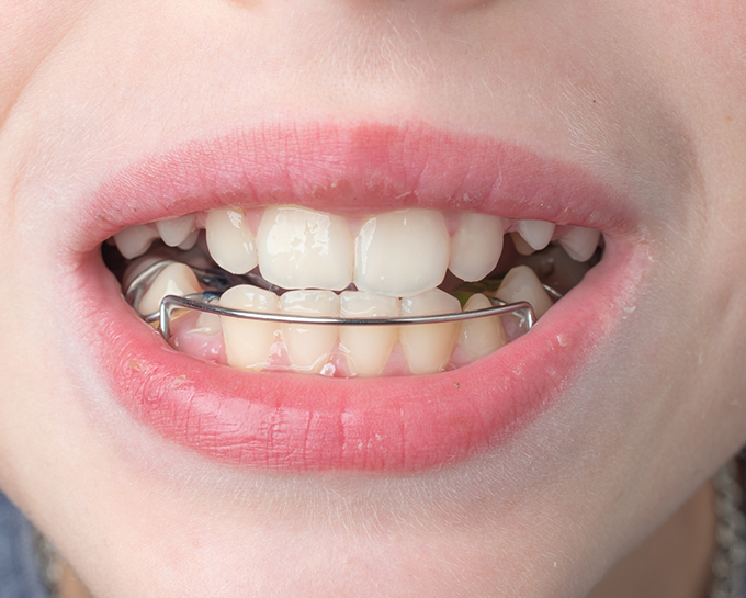 Close up of a mouth with an orthodontic wire on the lower arch of teeth