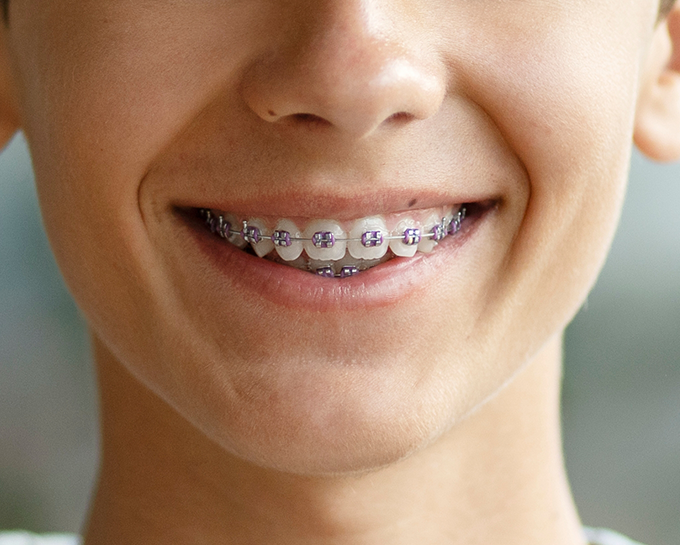 Close up of a child smiling with traditional braces