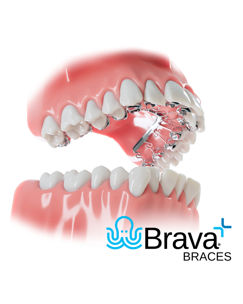 Custom Brava Braces