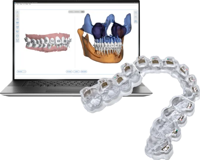 Custom Metal Braces