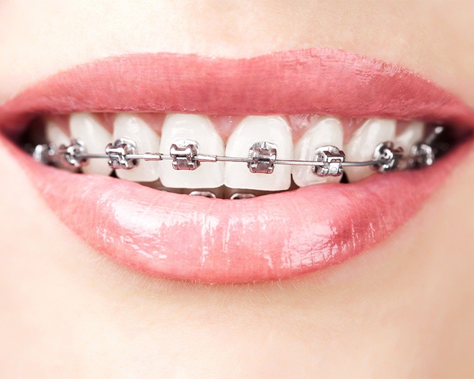 Metal Braces